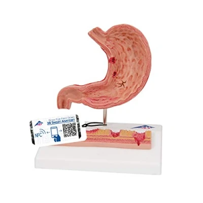 Imagen de 3B Scientific K17 Modelo de anatomía humana Estómago Con Úlceras Gástricas + App gratuita Smart Anatomy
