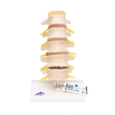 Imagen de 3B Scientific A795 Modelo Anatómico Humano Estadios del de la Hernia Discal y Degeneración Vertebral + App anatomía gratuita Smart Anatomy