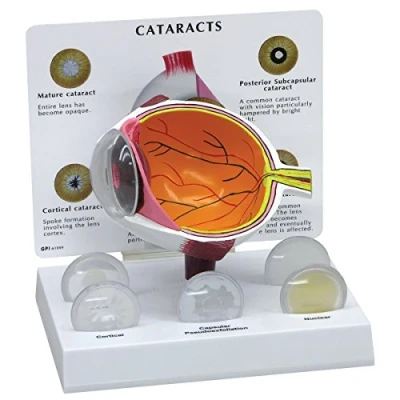 Imagen de GPI Anatomicals Ojo con catarata
