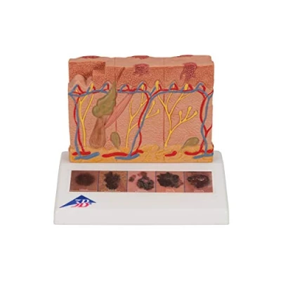 Imagen de 3B Scientific J15 Modelo de anatomía humana Cáncer Piel + App gratuita Smart Anatomy