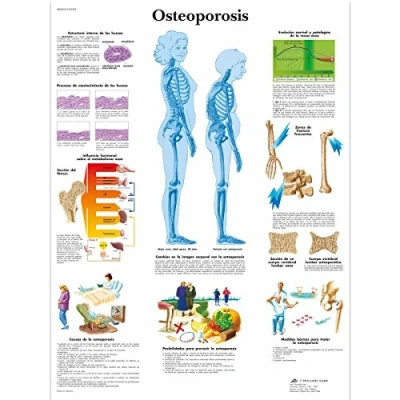 Imagen de 3B Scientific VR3121L Impreso En Papel, Osteoporosis