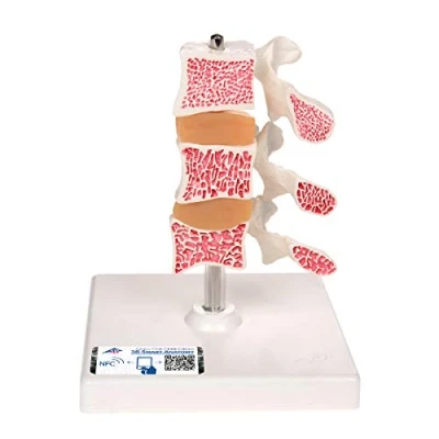 Imagen de 3B Scientific A78 Modelo de anatomía humana Osteoporosis, Versión Lujo (3 Vertebrales) + App gratuita Smart Anatomy