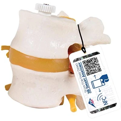 Imagen de 3B Scientific A76/9 Modelo Anatómico Humano Discos Lumbares, con Hernia Discal, Montados Flexibles + App de anatomía gratuita Smart Anatomy, 2 Disca