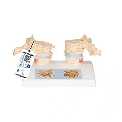 Imagen de 3B Scientific A95 Modelo de anatomía humana Osteoporosis + App gratuita Smart Anatomy